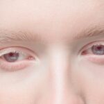 ¿existe albinismo ocular?